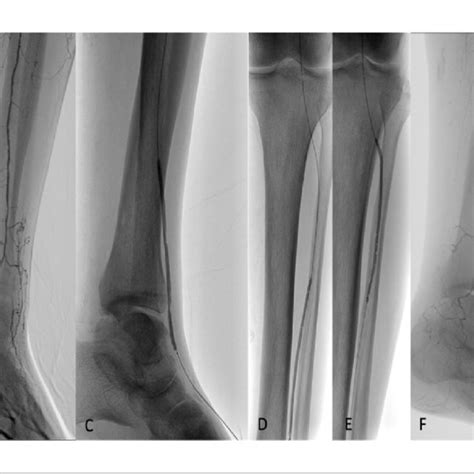 Transpedal Group A And B Initial Angiogram Demonstrates A Long Download Scientific Diagram