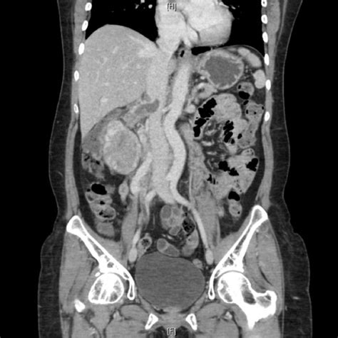 Cross Sectional Computed Tomography Imaging Of The Abdomen And Pelvis