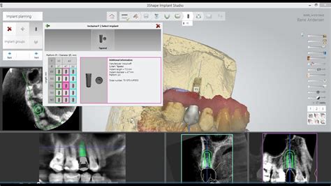 Digital Implant Planning And Surgical Guide Design 3shape Implant Studio