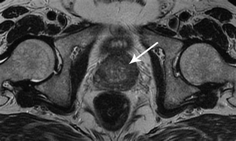 MRI could solve prostate cancer overdiagnosis | InSight+