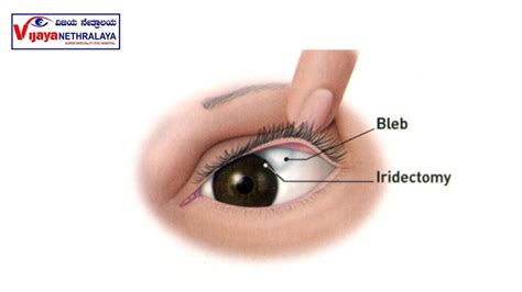 Trabeculectomy The Ultimate Guide To Treating Glaucoma