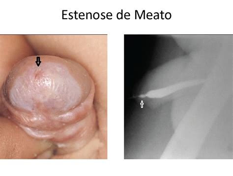 Estenose Da Uretra Dr Paulo Rodrigues