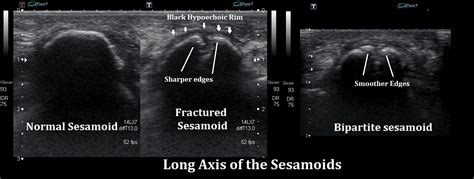 Sesamoid Fracture Ankle Foot And Orthotic Centre