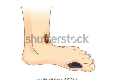 Diabetic Foot Pain Ulcers Skin Sores Stockvektor Royaltyfri 522202219