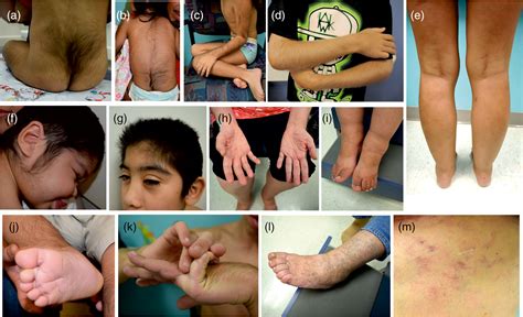 Cant Syndrome Findings From Patients In The International Cant