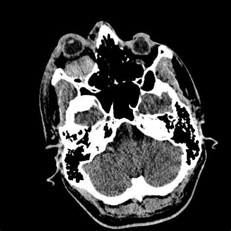 Transaxial CT Showing The Retrobulbar Haematoma And Exophthalmus On