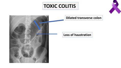 Ulcerative Colitis Complications Management Ppt