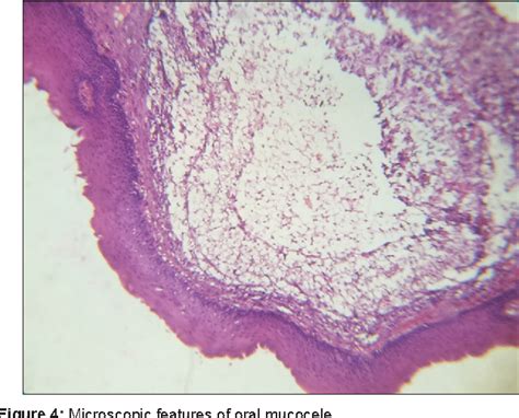 Mucocele Histology