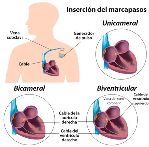 Los Diferentes Tipos De Marcapasos My Rhythm Device