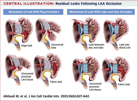 Peridevice Leak After Left Atrial Appendage Occlusion Incidence