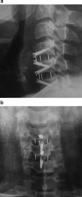 A Post Operative Lateral Radiograph B Post Operative Ap Radiograph Download Scientific Diagram