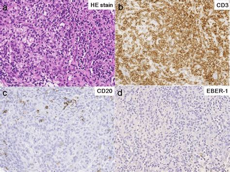 Pathology Of Axillary Lymph Nodes Histology Of Biopsy Specimens He