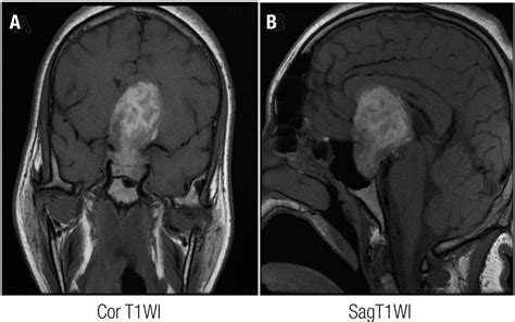 Apoplexy In Sporadic Pituitary Adenomas A Single Referral Center