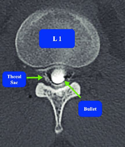 Computed Tomography Myelogram Image Of The Lumbar Spine Axial View At Download Scientific