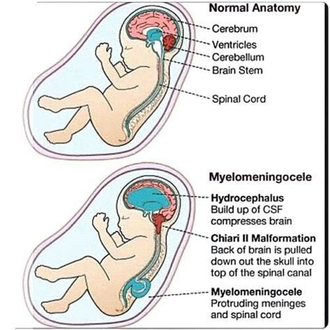 Myelomeningocele | Nursing school survival, Medical school essentials ...