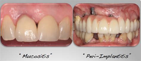 What Is Implant Disease Anderson Periodontal Wellness Bloomfield