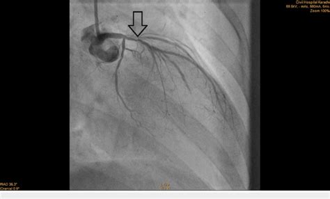 Angiogram Of Lad Coronary Artery Showing Critical Ostial Lesion Arrow