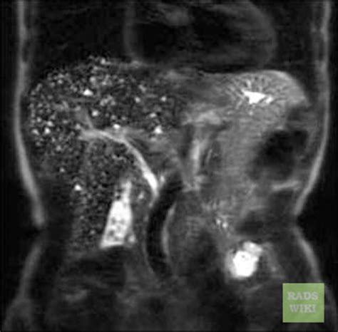 Hamartoma Mri Wikidoc