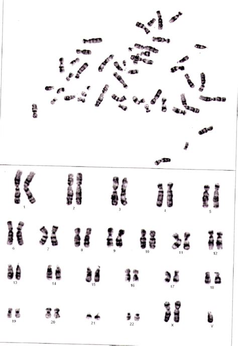 Klinefelters Syndrome Karyotype