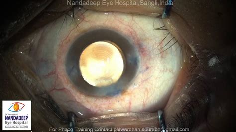 Dr Sourabh Patwardhan Live Cataract Nsultation Call 9220001000 Side Incision Suturing