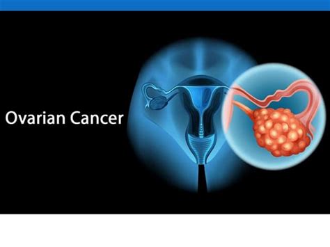 Cancer Of The Female Genital Tract Ppt