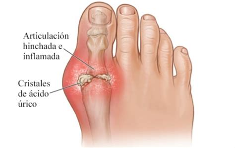 Gota Síntomas causas y tratamientos de esta enfermedad
