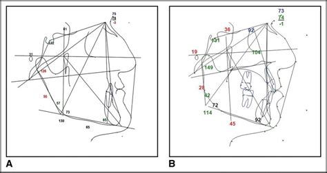 A comparison between cephalometric analysis of the patient before and ...