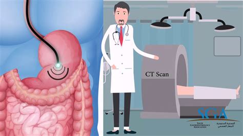 Endoscopic Ultrasound Procedure