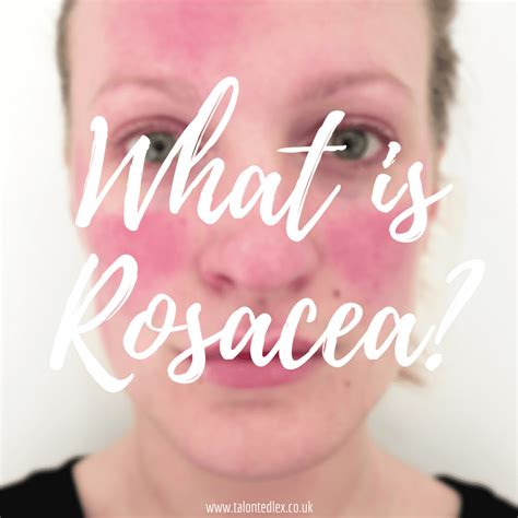 What Is Rosacea Skincare And How To Work Around The Condition