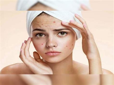 Acne Problem On Face Due To Deficiency Of Vitamins A B3 D E Know Its