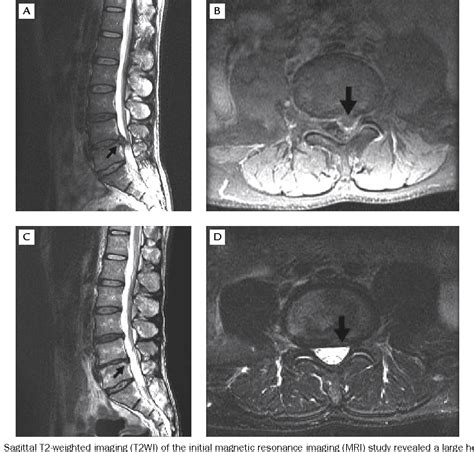 Figure 1 From Spontaneous Regression Of Lumbar Herniated Disc