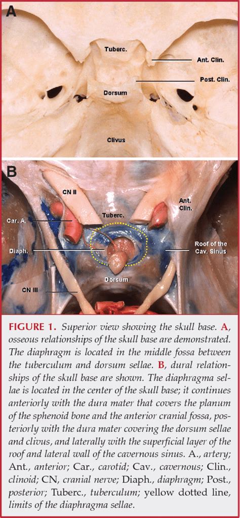 Figure 3 from MICROSURGICAL ANATOMY OF THE DIAPHRAGMA SELLAE AND ITS ROLE IN DIRECTING THE ...