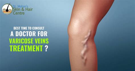 When To Consult A Doctor For Varicose Veins