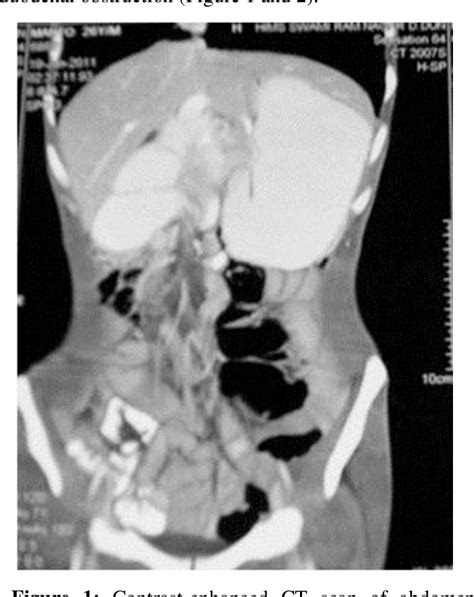 Figure 1 From Adult Intestinal Malrotation Presenting As Midgut Volvulus Case Report Barsak