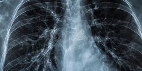 Healthy Pulmonary Anatomy Revealed By Chest X Ray Technique Stock