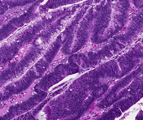 Pathology Of Pancreatic Cancer Precursor Lesions Surgical Pathology