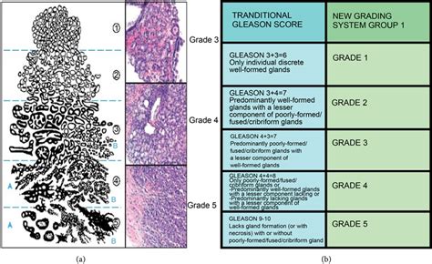 Prostate Cancer Histological Grades