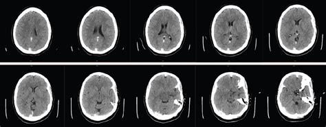 Management Of Vein Of Galen Thrombosis With Mechanical Thrombectomy