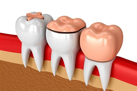 Inlays And Onlays Carntyne Dental Care