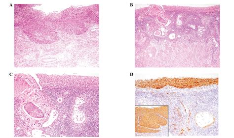 Atypical Squamous Cells Cervix