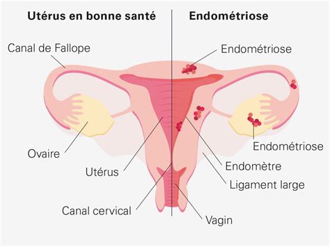 Mois De Mars Le Mois De Sensibilisation Lendom Triose