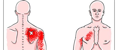 Alles Over Triggerpoints Schouder En Schouderklachten