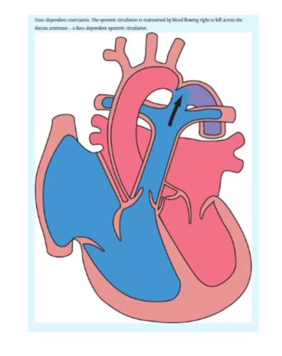 Congenital Heart Disease Flashcards Quizlet