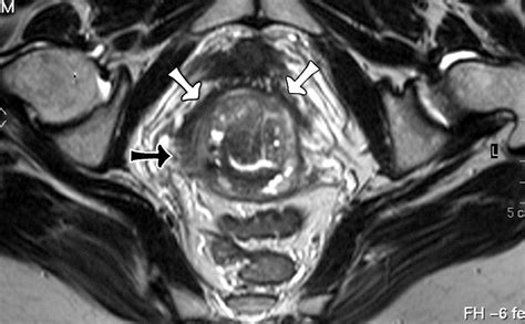 MR Imaging Of The Uterine Cervix Imaging Pathologic Correlation