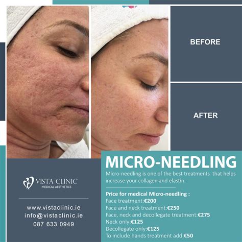 Transform Your Skin With Micro Needling At Vista Clinic Advanced Face And Neck Treatment For