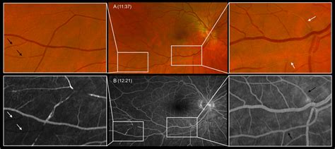 Multimodal Imaging Of The Right Eye At Presentation A Scanning Laser