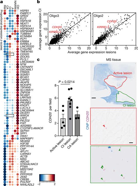 Differential Gene Expression Analysis Of Ms Lesions Reveals Potential