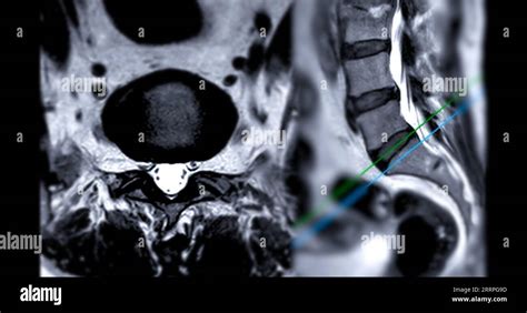 Mri L S Spine Or Lumbar Spine Axial And Sagittal T2 Technique With