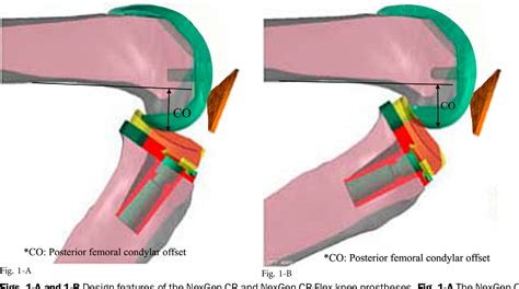 Figure 1 From Range Of Motion Of Standard And High Flexion Posterior