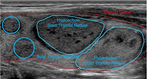 Normal vs. Abnormal Thyroid on Ultrasound - RFA For Life